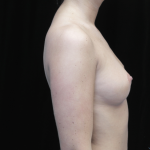 Breast Augmentation (Implants) Before & After Patient #14311