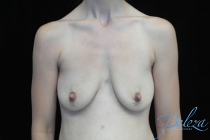 Breast Lift with Implants Before & After Patient #14485