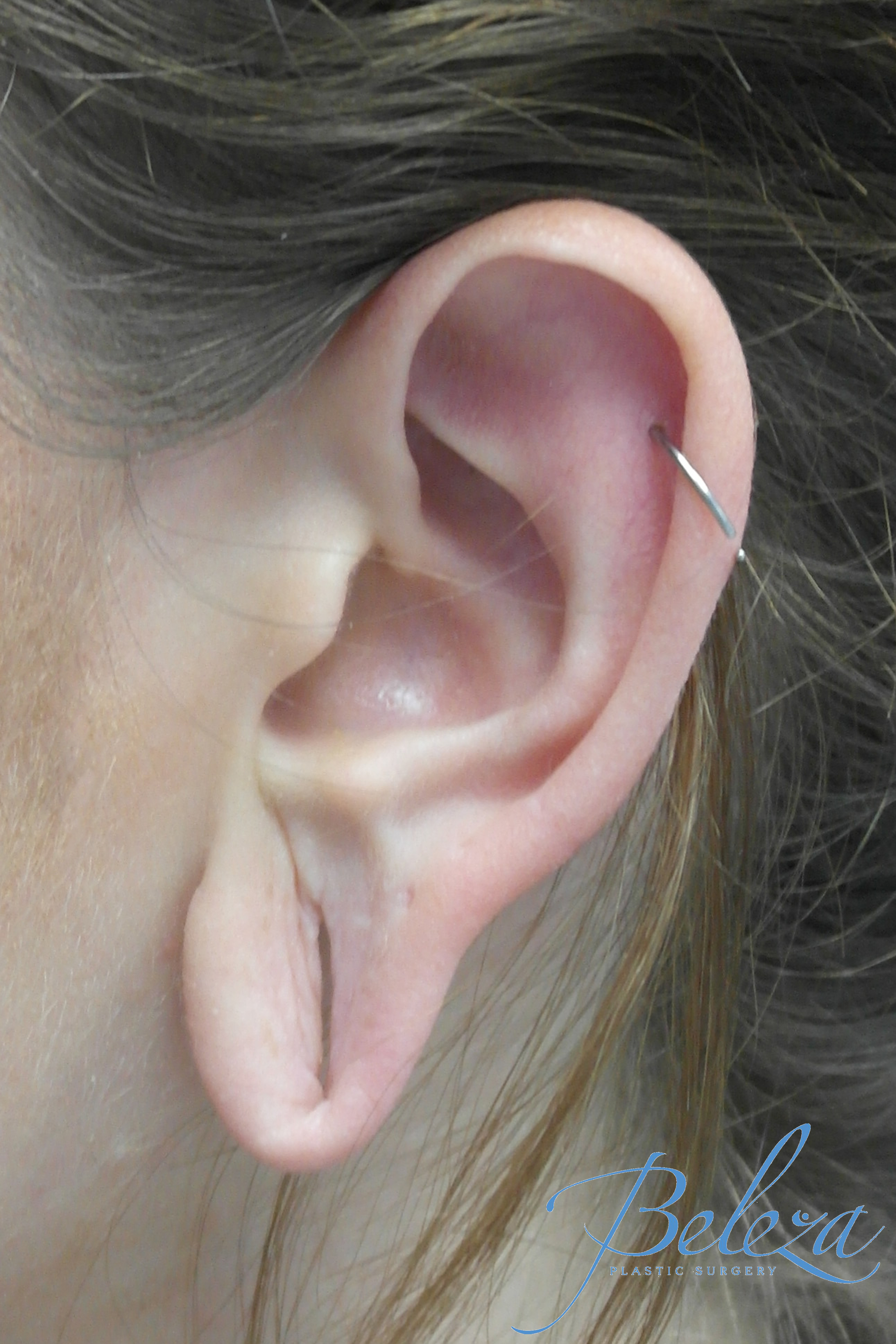 Earlobe Repair Before & After Patient #14827
