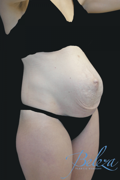 Mommy Makeover Before & After Patient #15260