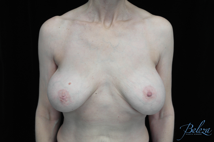 Breast Revision Before & After Patient #14656