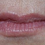Lip Augmentation - Fillers Before & After Patient #14873