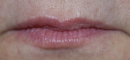 Lip Augmentation - Fillers Before & After Patient #14873