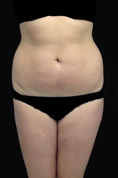 Liposuction Before & After Patient #15052