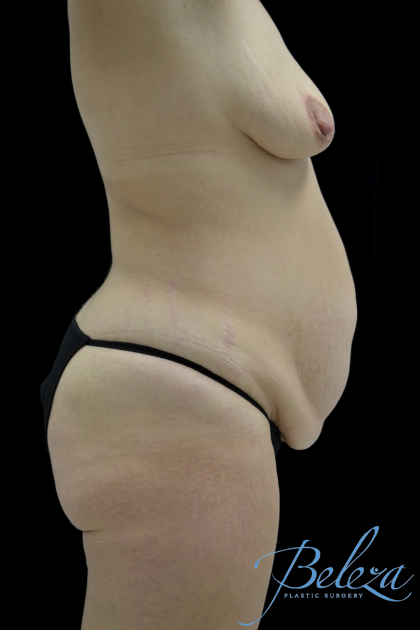 Mommy Makeover Before & After Patient #15281