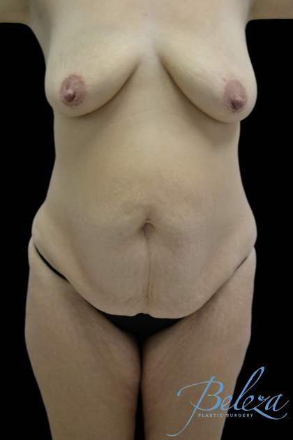 Mommy Makeover Before & After Patient #15281