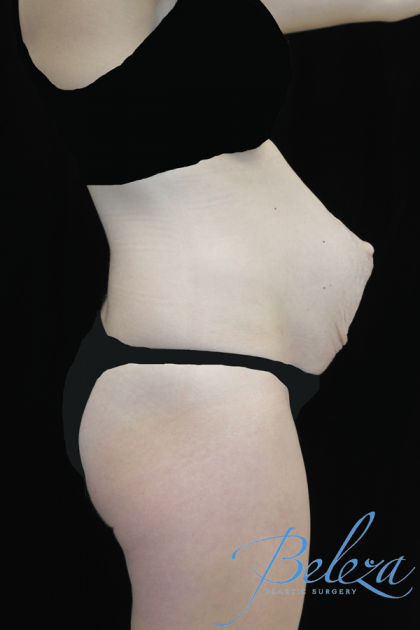 Mommy Makeover Before & After Patient #15260