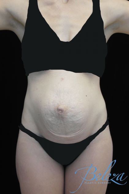 Mommy Makeover Before & After Patient #15260