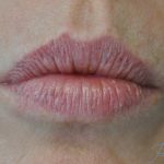 Lip Augmentation - Fillers Before & After Patient #14852