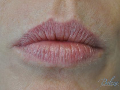 Lip Augmentation - Fillers Before & After Patient #14852