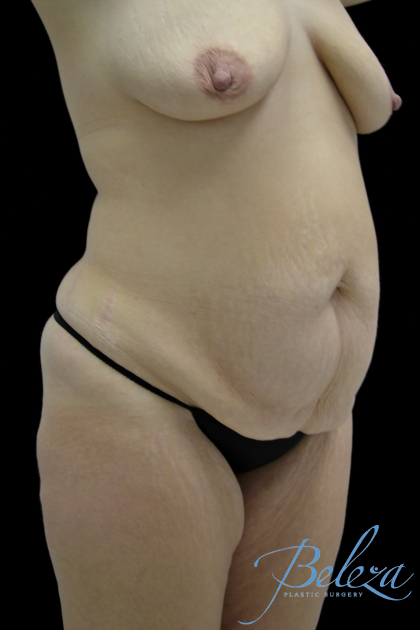 Mommy Makeover Before & After Patient #15281