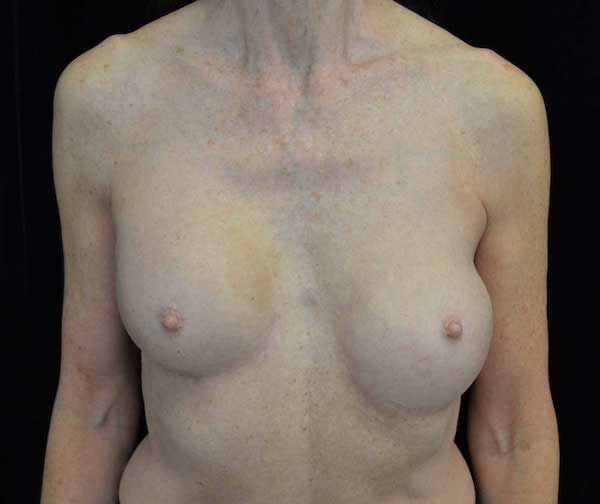 Breast Revision Before & After Patient #14719