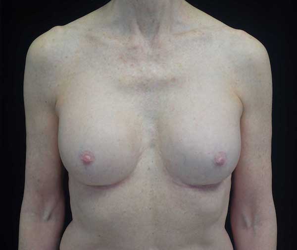 Breast Revision Before & After Patient #14719