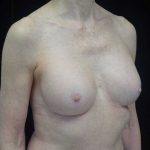 Breast Revision Before & After Patient #14719