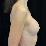 Breast Revision Before & After Patient #14719