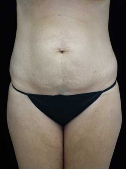 Lipoabdominoplasty Before & After Patient #15145