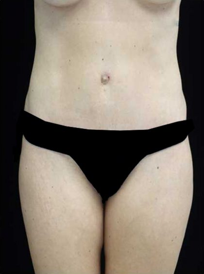 Lipoabdominoplasty Before & After Patient #15145