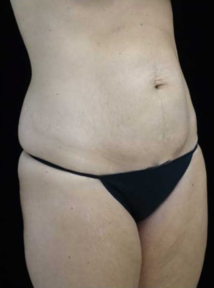 Lipoabdominoplasty Before & After Patient #15145
