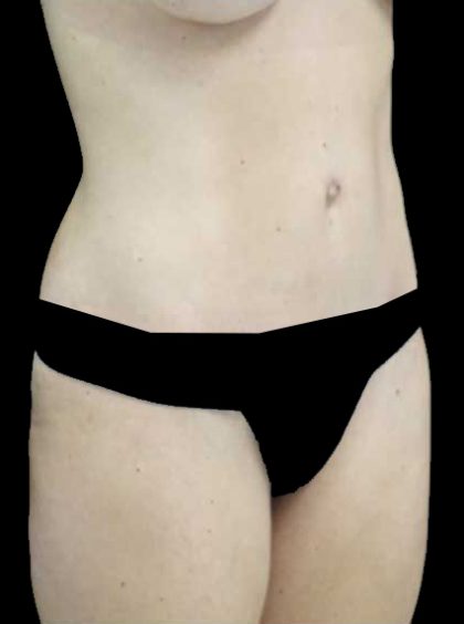 Lipoabdominoplasty Before & After Patient #15145