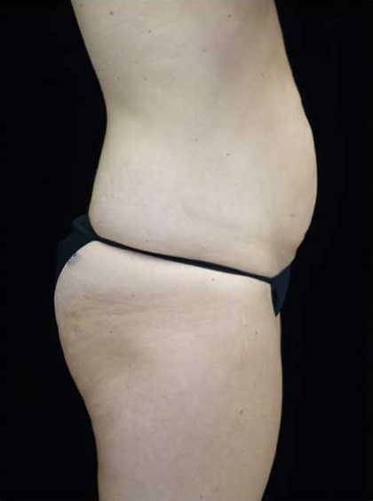 Lipoabdominoplasty Before & After Patient #15145