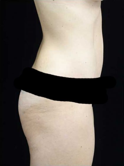 Lipoabdominoplasty Before & After Patient #15145