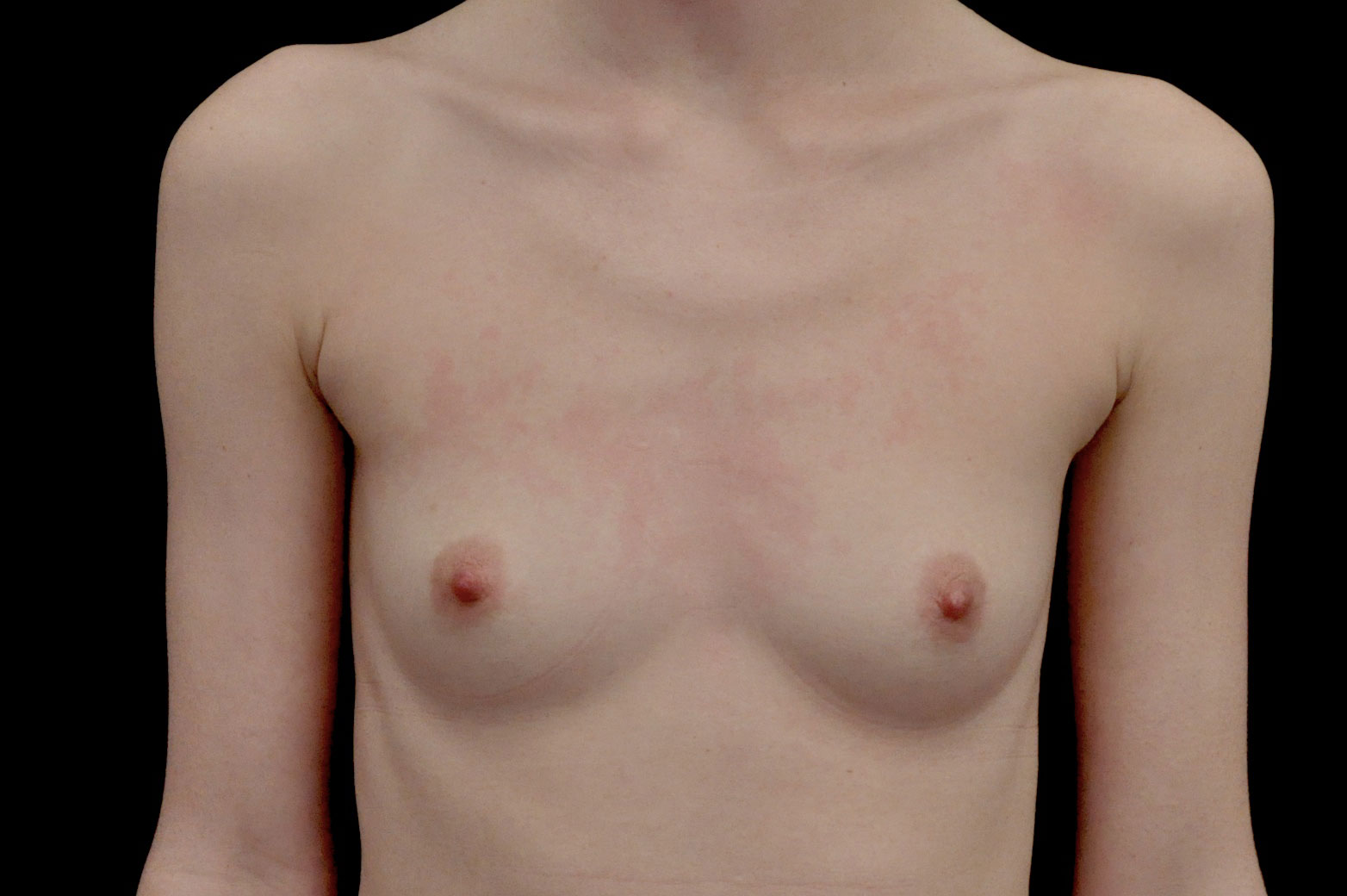 Breast Augmentation (Fat Transfer) Before & After Patient #14002