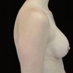 Breast Augmentation (Implants) Before & After Patient #14036