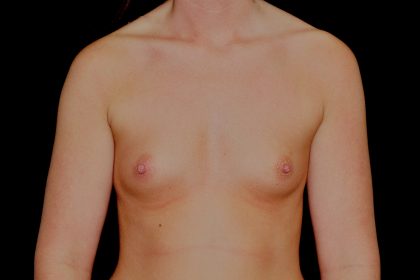 Breast Augmentation (Implants) Before & After Patient #14261
