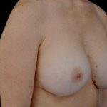 Breast Augmentation (Implants) Before & After Patient #14268