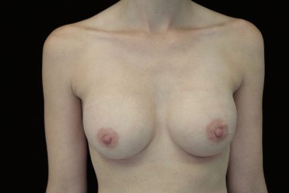Breast Augmentation (Implants) Before & After Patient #14036