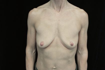 Breast Augmentation (Implants) Before & After Patient #14293