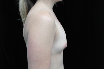 Breast Augmentation (Implants) Before & After Patient #14369