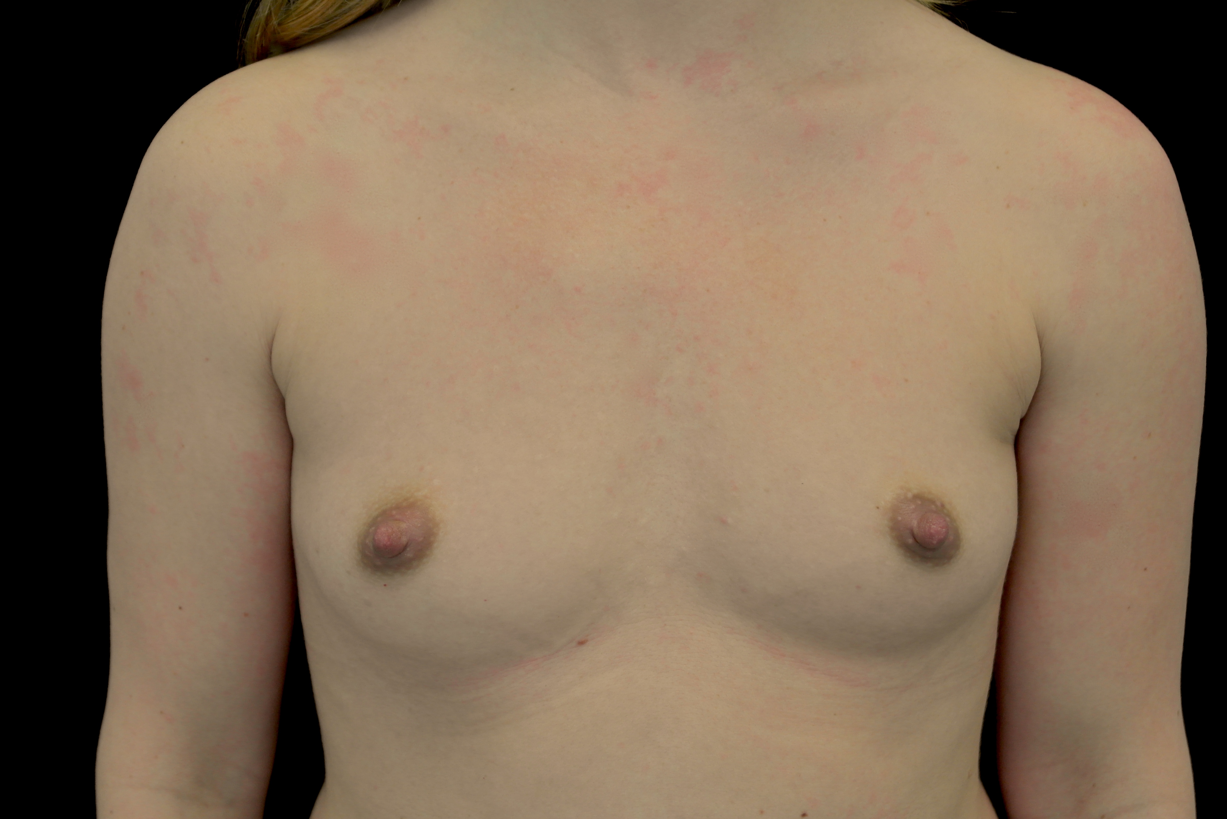 Breast Augmentation (Implants) Before & After Patient #14253