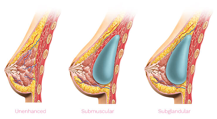 Subglandular and Submuscular Breast Implants. Breast implant shapes  Teardrop shape and Round shape. Breast implant types. Stock Vector