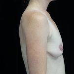 Breast Lift with Implants Before & After Patient #14539