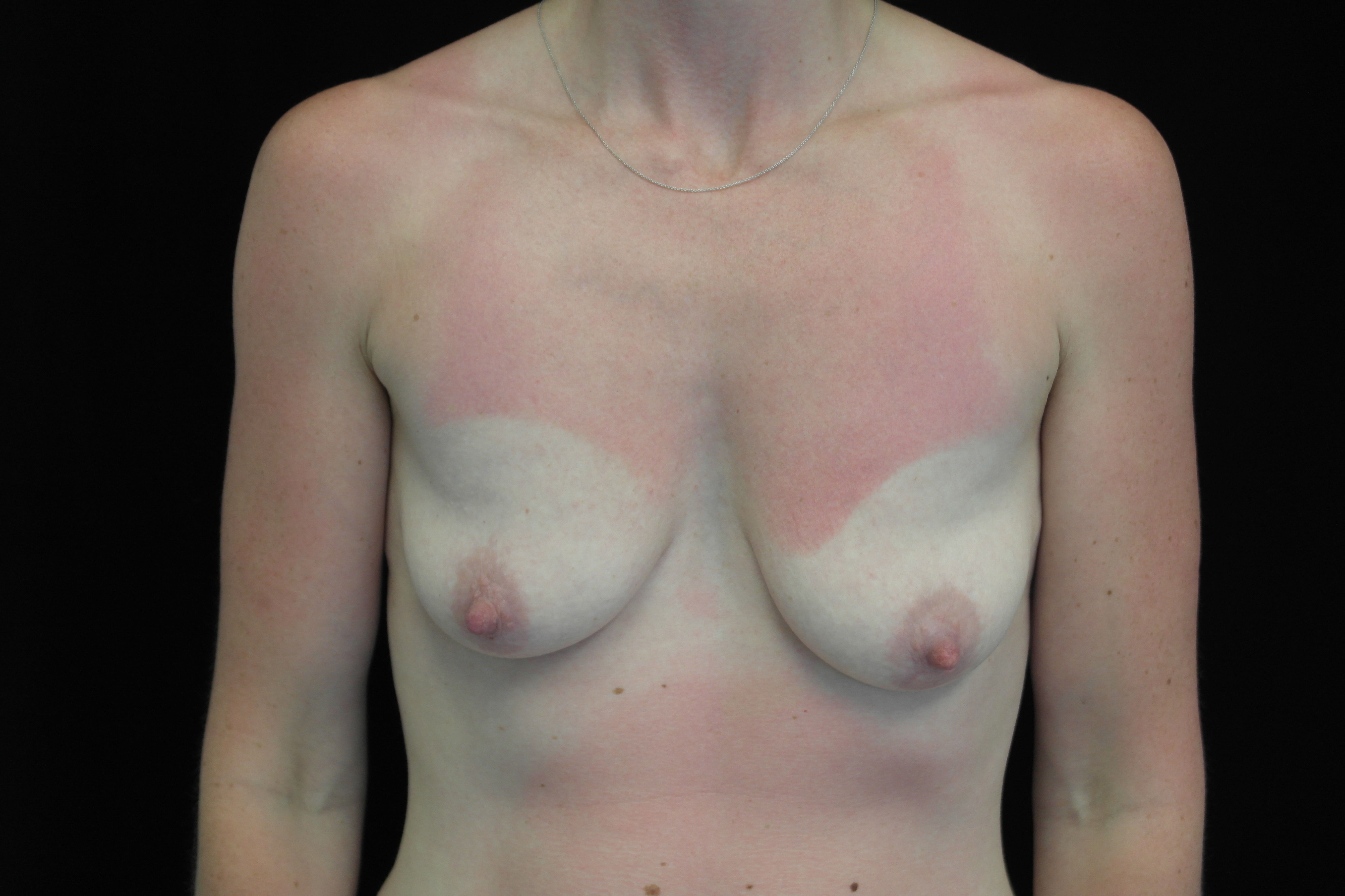 Breast Lift with Implants Before & After Patient #14521