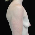 Breast Lift with Implants Before & After Patient #14521