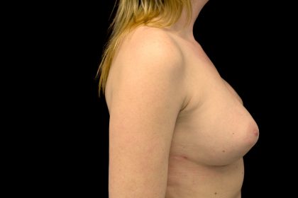 Breast Reconstructions Before & After Patient #15225