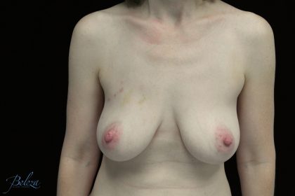 Breast Reconstructions Before & After Patient #15229