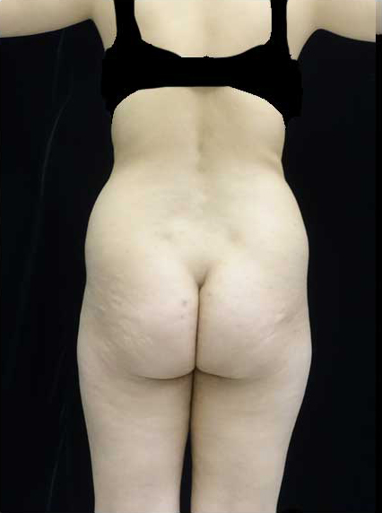 Buttock Augmentation Before & After Patient #14761