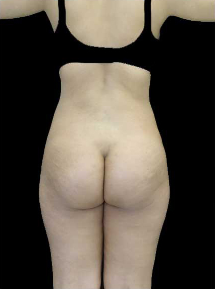 Buttock Augmentation Before & After Patient #14761