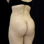 Buttock Augmentation Before & After Patient #14761
