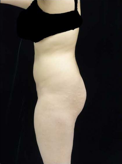 Buttock Augmentation Before & After Patient #14761