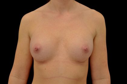 Breast Augmentation (Implants) Before & After Patient #14261