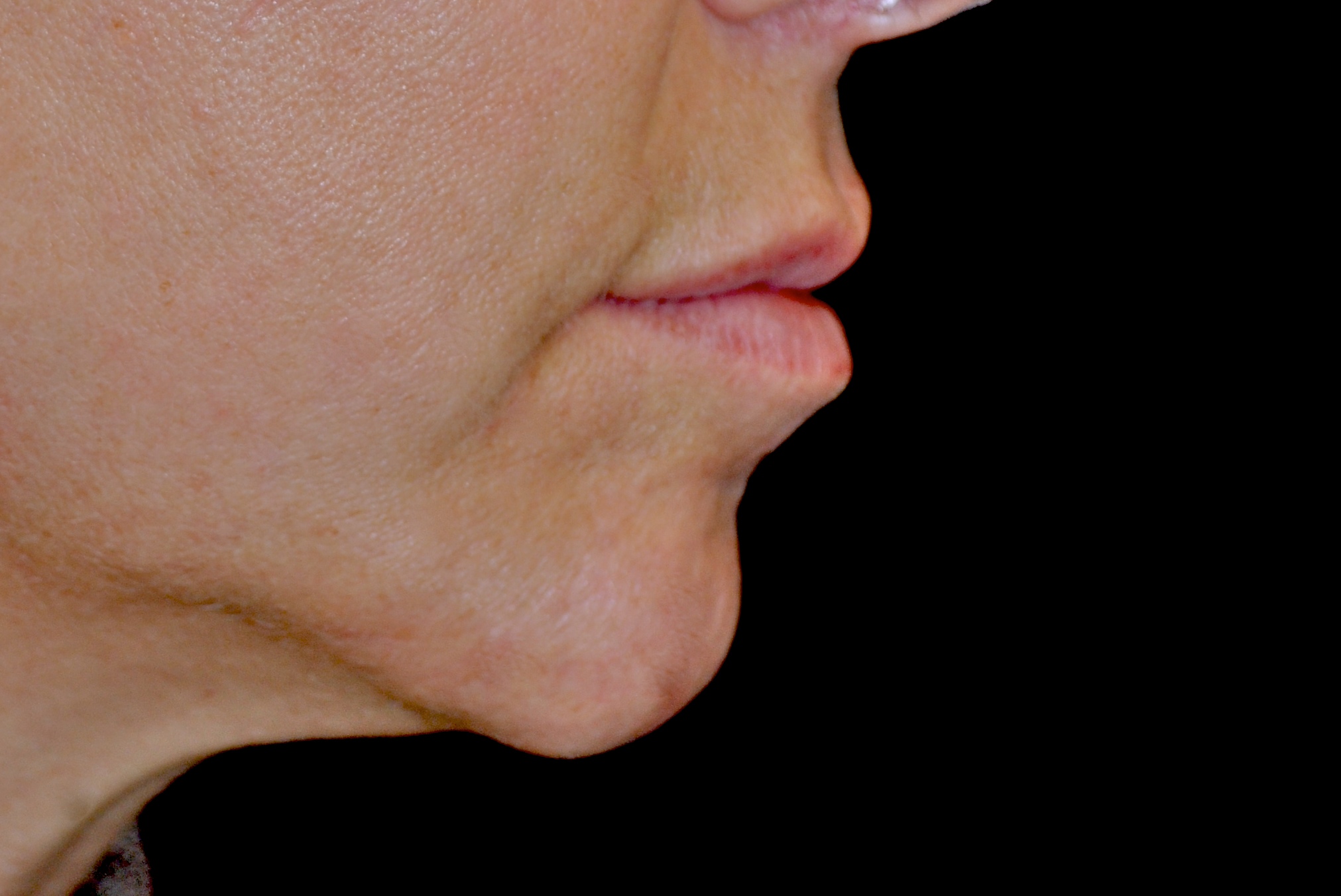 Chin & Jawline Filler Before & After Patient #14845