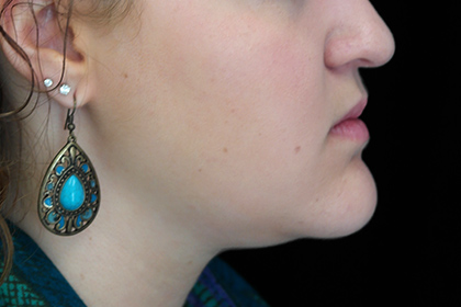 Chin Reduction Before & After Patient #14959