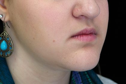 Chin Reduction Before & After Patient #14959