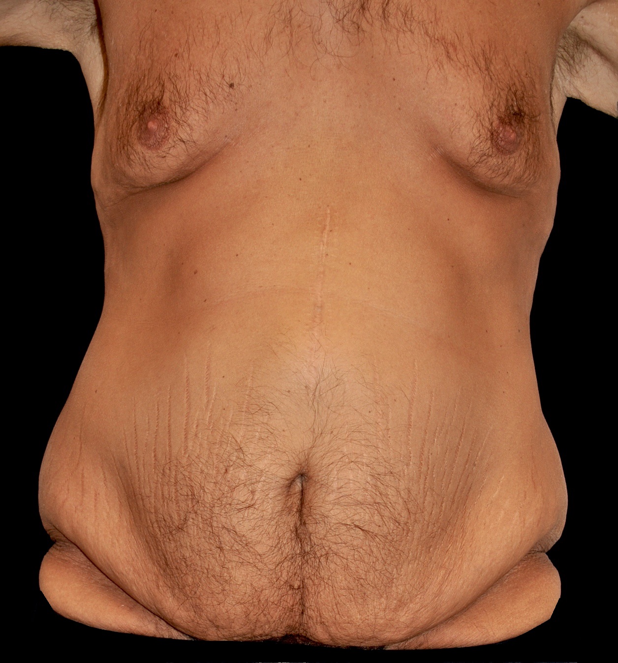 Lower Body Lift Before & After Patient #15316