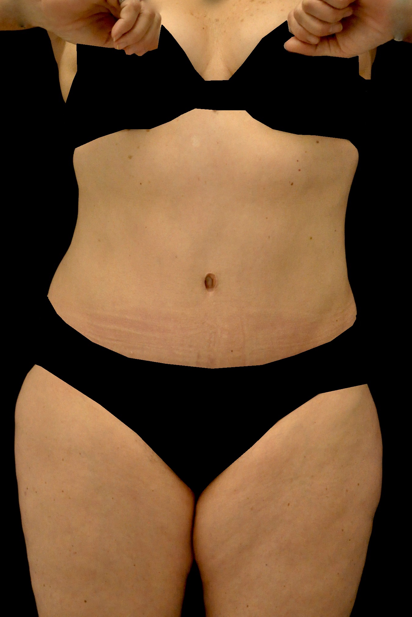 Tummy Tuck Before & After Patient #15125