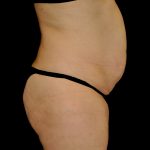 Tummy Tuck Before & After Patient #15125
